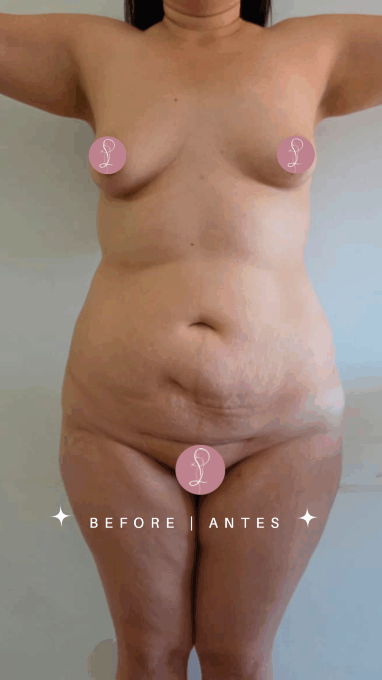 Lipoabdominoplastia Dra Paola Leon