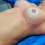 Dra Paola Leon Mamoplastia de Aumento