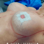 Dra Paola Leon Mamoplastia de Aumento