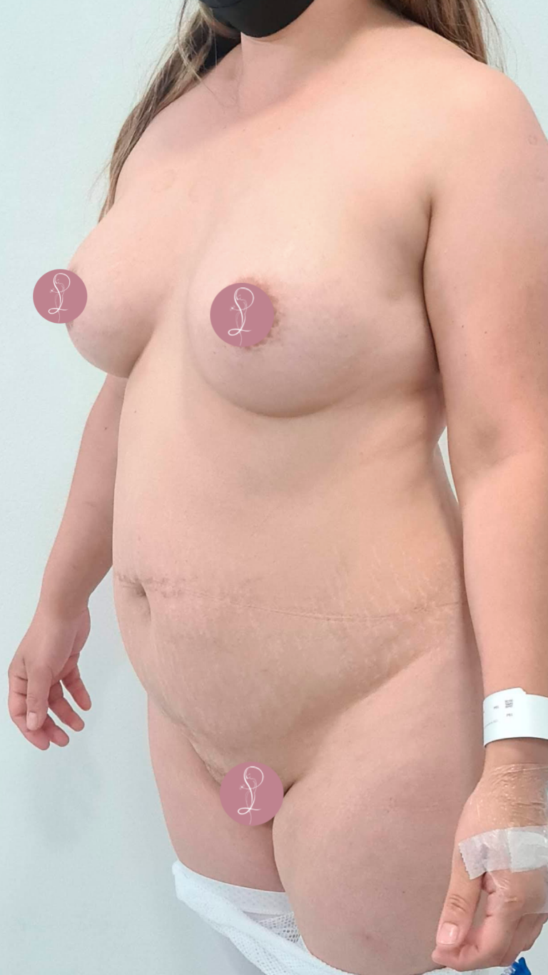 Lipoescultura Dra Paola Leon